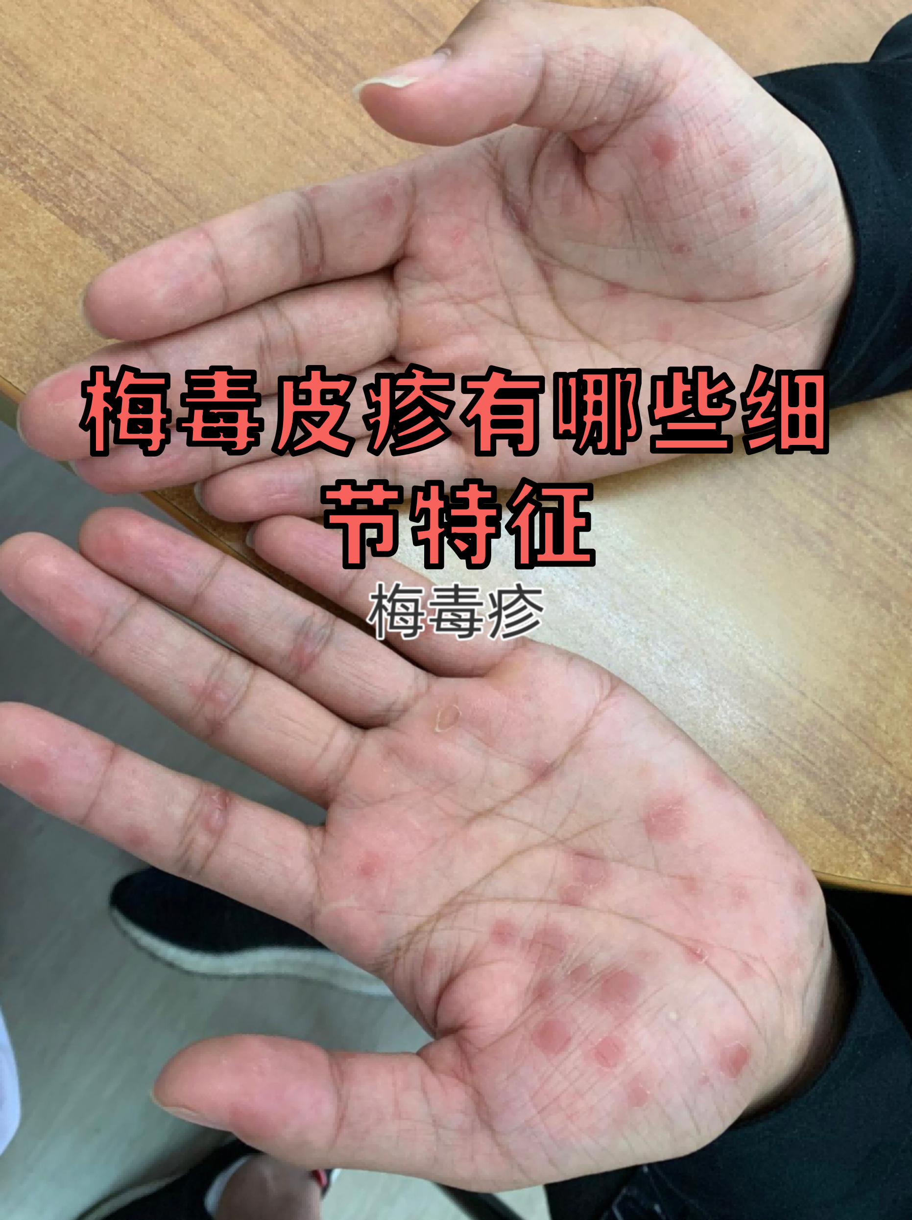 【全国梅毒疫情地区分布,中国梅毒高发地区】-第1张图片